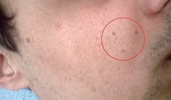 Siyah Nokta Nedir