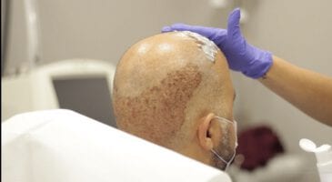 en iyi saç ekim merkezi